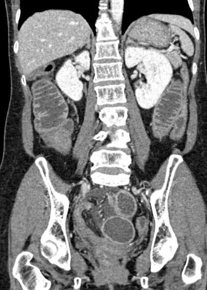 Adhesional small bowel obstruction (Radiopaedia 48397-53305 Coronal C+ portal venous phase 224).jpg