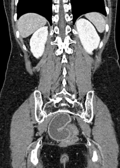 Adhesional small bowel obstruction (Radiopaedia 48397-53305 Coronal C+ portal venous phase 276).jpg