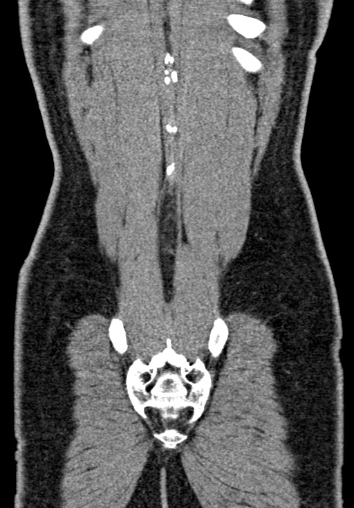 Adhesional small bowel obstruction (Radiopaedia 58900-66131 Coronal C+ portal venous phase 220).jpg