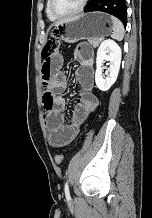 Adhesional small bowel obstruction (Radiopaedia 58900-66131 Sagittal C+ portal venous phase 183).jpg