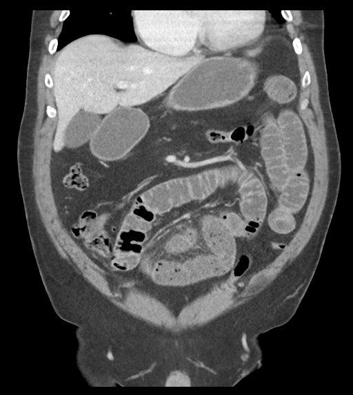 Adhesions within abdominal wall hernia (Radiopaedia 58283-65394 Coronal C+ portal venous phase 28).png