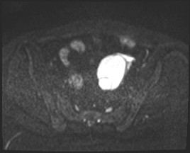 Adnexal multilocular cyst (O-RADS US 3- O-RADS MRI 3) (Radiopaedia 87426-103754 Axial DWI 38).jpg