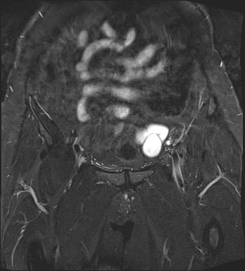 File:Adnexal multilocular cyst (O-RADS US 3- O-RADS MRI 3) (Radiopaedia 87426-103754 Coronal T2 fat sat 8).jpg