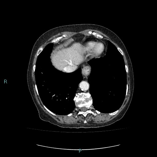 File:Adrenal collision tumor (ACT) (Radiopaedia 48462-53379 Axial C+ portal venous phase 5).jpg
