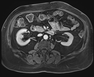 Adrenal cortical carcinoma (Radiopaedia 64017-72770 K 47).jpg