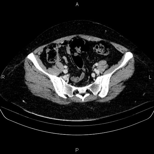 Adrenal cortical carcinoma (Radiopaedia 84882-100379 Axial C+ portal venous phase 75).jpg