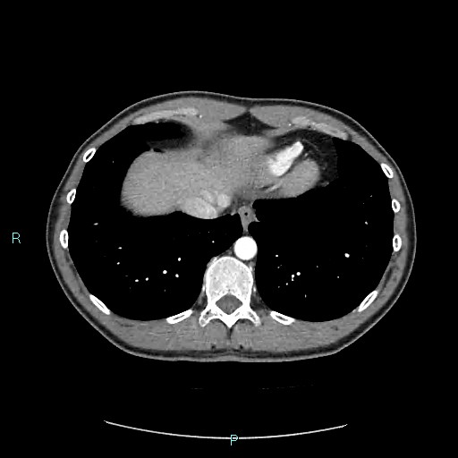 Adrenal cystic lymphangioma (Radiopaedia 83161-97534 Axial C+ arterial phase 12).jpg