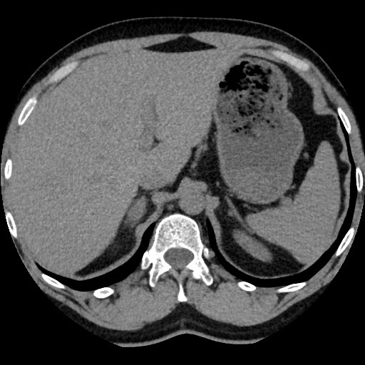 Adrenal gland trauma (Radiopaedia 81351-95079 Axial non-contrast 26).jpg