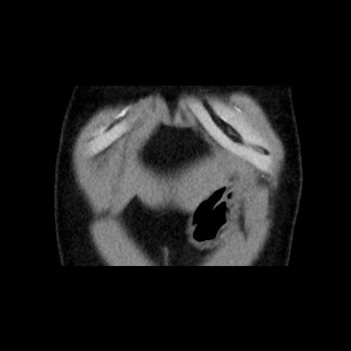 Adrenal gland trauma (Radiopaedia 81351-95079 Coronal non-contrast 13).jpg