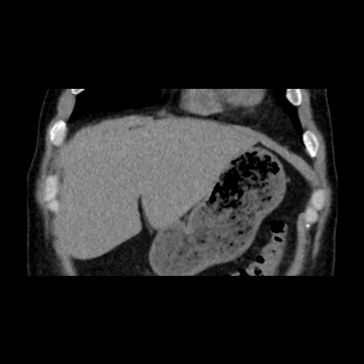 File:Adrenal gland trauma (Radiopaedia 81351-95079 Coronal non-contrast 21).jpg