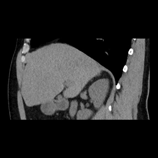 Adrenal gland trauma (Radiopaedia 81351-95079 Sagittal non-contrast 35).jpg