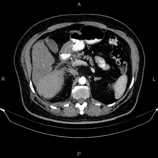 Adrenal hemorrhage (Radiopaedia 62622-70916 Axial C+ arterial phase 129).jpg