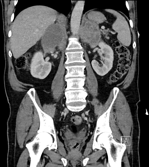 Adrenal lymphoma (Radiopaedia 73730-84529 Coronal C+ portal venous phase 50).jpg