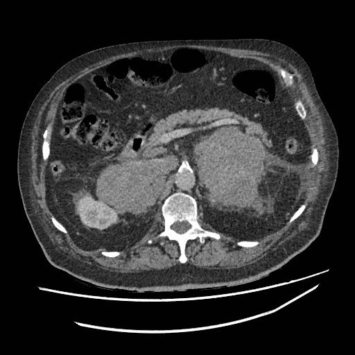 Adrenal lymphoma (Radiopaedia 84145-99415 Axial C+ portal venous phase 41).jpg