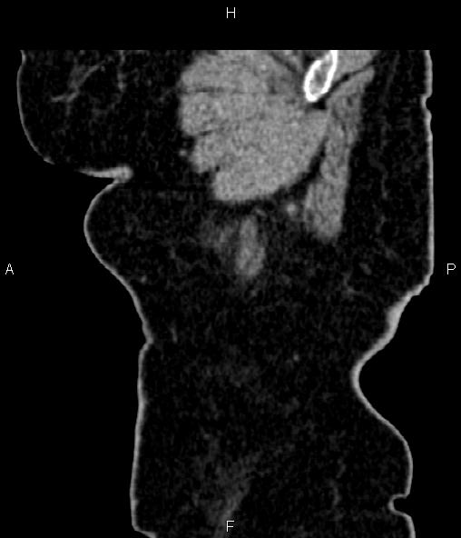 File:Adrenal myelolipoma (Radiopaedia 82742-96986 Sagittal renal cortical phase 11).jpg