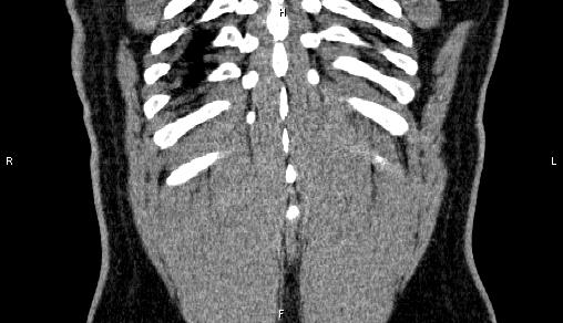 Adrenal myelolipoma (Radiopaedia 84321-99619 Coronal non-contrast 73).jpg