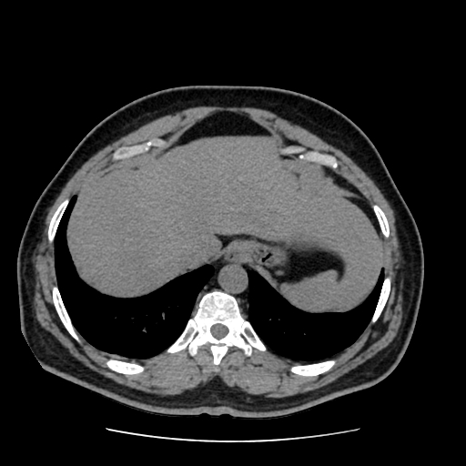 Adrenal myelolipoma and beaver tail liver (Radiopaedia 86201-102193 Axial non-contrast 63).jpg