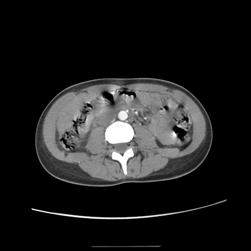 Adult polycystic kidney disease (Radiopaedia 48845-53876 Axial renal cortical phase 36).jpg