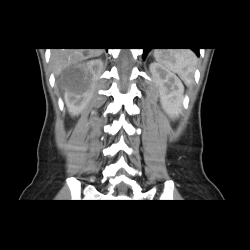 File:Adult polycystic kidney disease (Radiopaedia 48845-53876 Coronal renal cortical phase 30).jpg