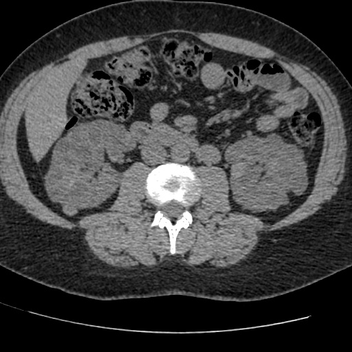 Adult polycystic kidney disease (Radiopaedia 59075-66368 Axial non-contrast 41).jpg