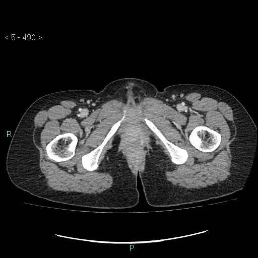 Adult transient intestinal intussusception (Radiopaedia 34853-36310 Axial C+ portal venous phase 134).jpg