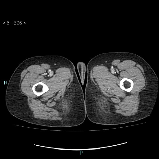File:Adult transient intestinal intussusception (Radiopaedia 34853-36310 Axial C+ portal venous phase 146).jpg