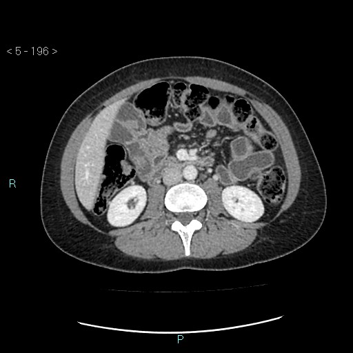 File:Adult transient intestinal intussusception (Radiopaedia 34853-36310 Axial C+ portal venous phase 35).jpg