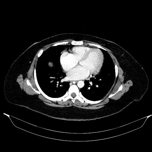 File:Afferent loop syndrome - secondary to incarcerated trocar site hernia (Radiopaedia 82959-97305 Axial C+ portal venous phase 9).jpg