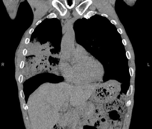 Air bronchogram in pneumonia (Radiopaedia 85719-101512 Coronal non-contrast 18).jpg