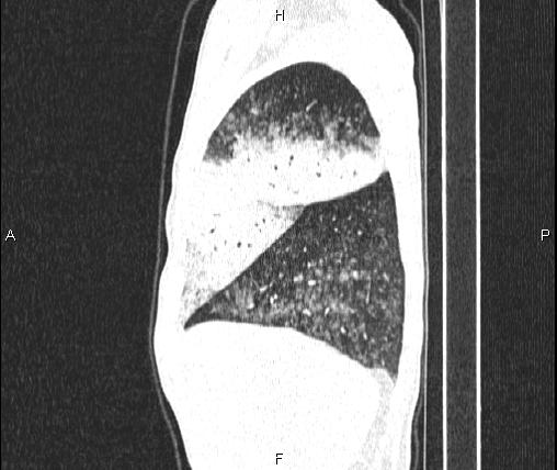 Air bronchogram in pneumonia (Radiopaedia 85719-101512 Sagittal lung window 19).jpg