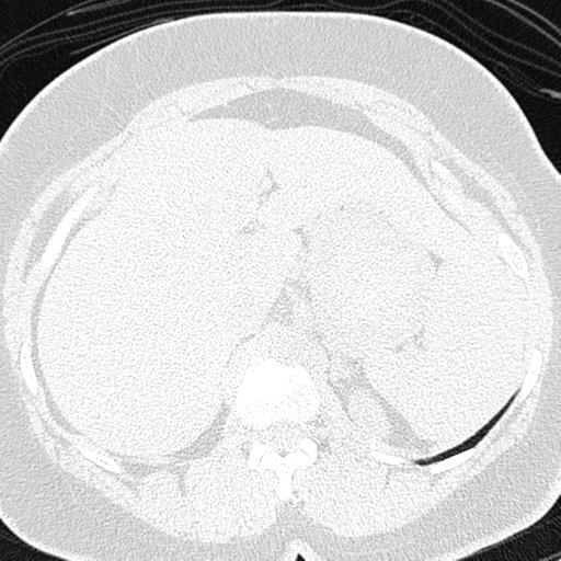 File:Air trapping in small airway disease (Radiopaedia 61685-69694 Axial lung window 200).jpg