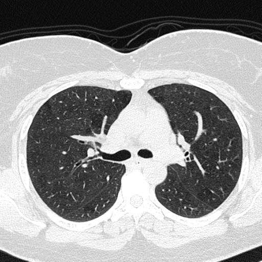 Air trapping in small airway disease (Radiopaedia 61685-69694 Axial lung window 64).jpg