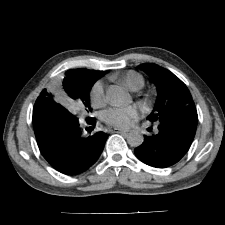 Airway foreign body in adult (Radiopaedia 85907-101779 Axial liver window 101).jpg