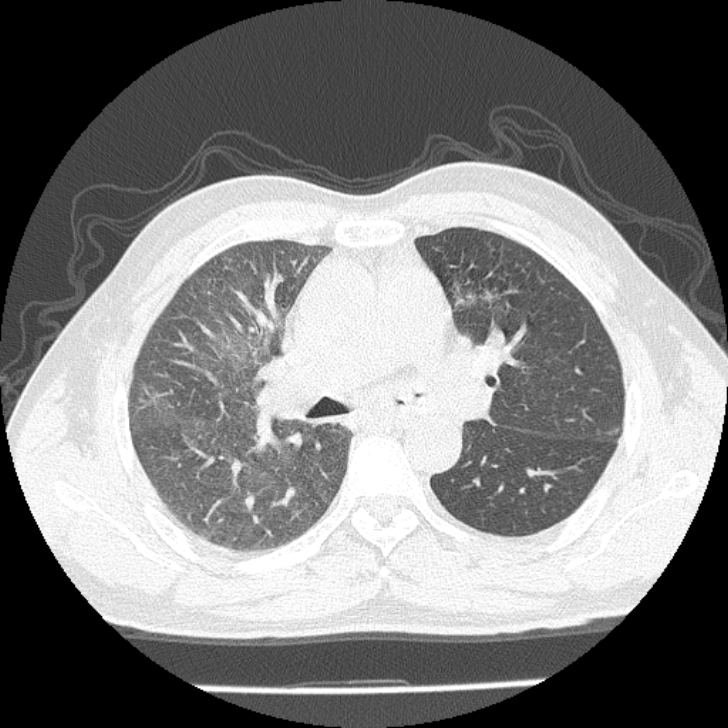 Airway foreign body in adult (Radiopaedia 85907-101779 Axial lung window 66).jpg