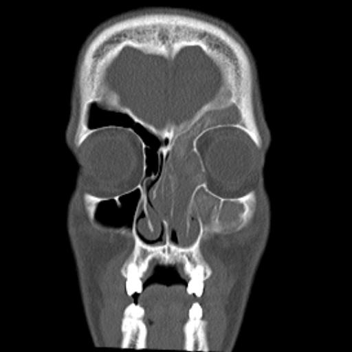 File:Allergic fungal sinusitis (Radiopaedia 29086-29455 Coronal bone window 16).jpg