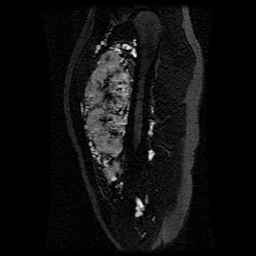 Alveolar soft part sarcoma (Radiopaedia 64501-73678 D 91).jpg