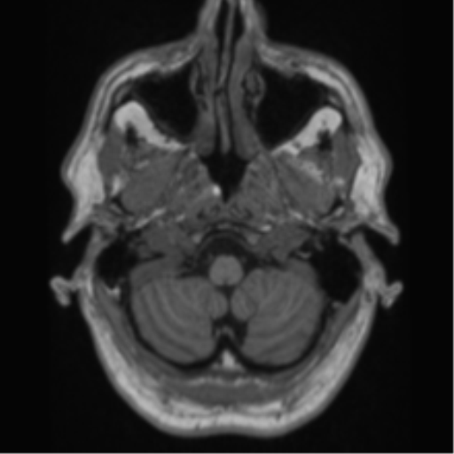 Alzheimer's disease- with Gerstmann syndrome and dressing apraxia (Radiopaedia 54882-61150 Axial T1 8).png