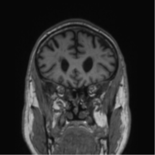 Alzheimer's disease- with Gerstmann syndrome and dressing apraxia (Radiopaedia 54882-61150 Coronal T1 67).png