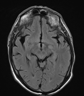 File:Alzheimer's disease- with apraxia (Radiopaedia 54763-61011 Axial FLAIR 12).png
