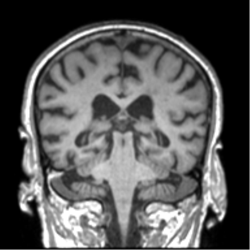 Alzheimer disease and cerebral amyloid angiopathy (Radiopaedia 64234-73011 Coronal T1 23).png