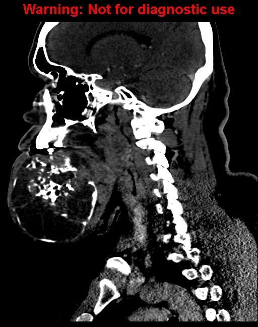 Ameloblastoma (Radiopaedia 33126-34164 F 31).jpg