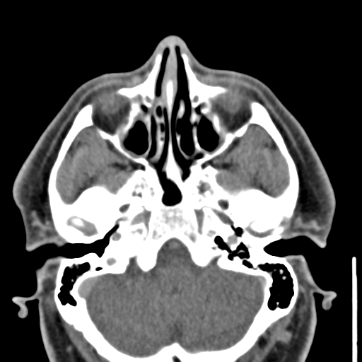 File:Ameloblastoma (Radiopaedia 33677-34806 Axial non-contrast 3).png