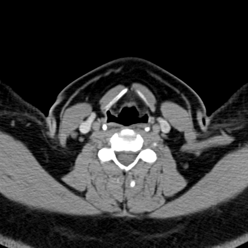 Ameloblastoma (Radiopaedia 38520-40623 Axial non-contrast 49).png