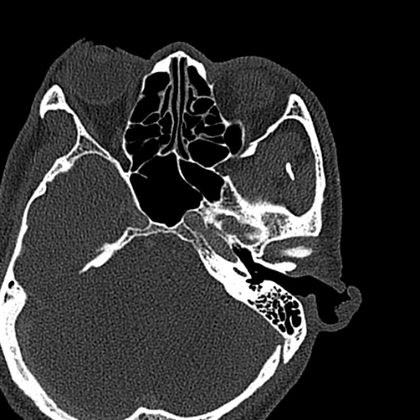 Ameloblastoma (Radiopaedia 51921-57766 Axial bone window 161).jpg