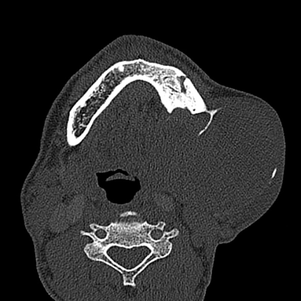 Ameloblastoma (Radiopaedia 51921-57766 Axial bone window 46).jpg
