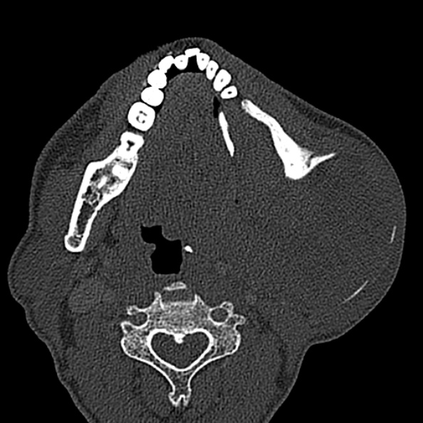 Ameloblastoma (Radiopaedia 51921-57766 Axial bone window 69).jpg