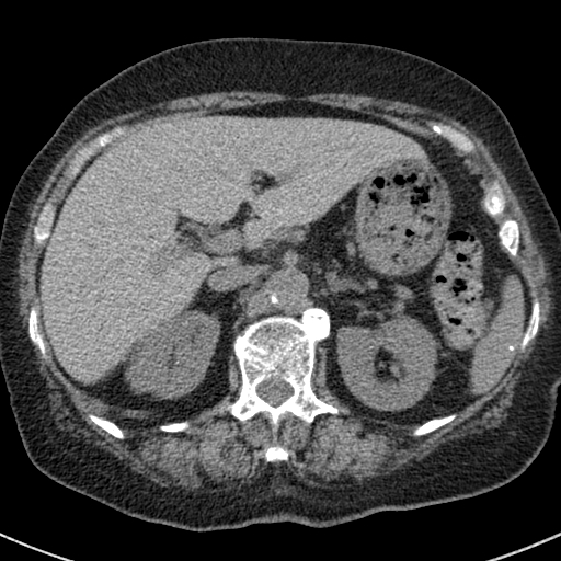 File:Amiodarone-induced pulmonary fibrosis (Radiopaedia 82355-96460 Axial non-contrast 61).jpg