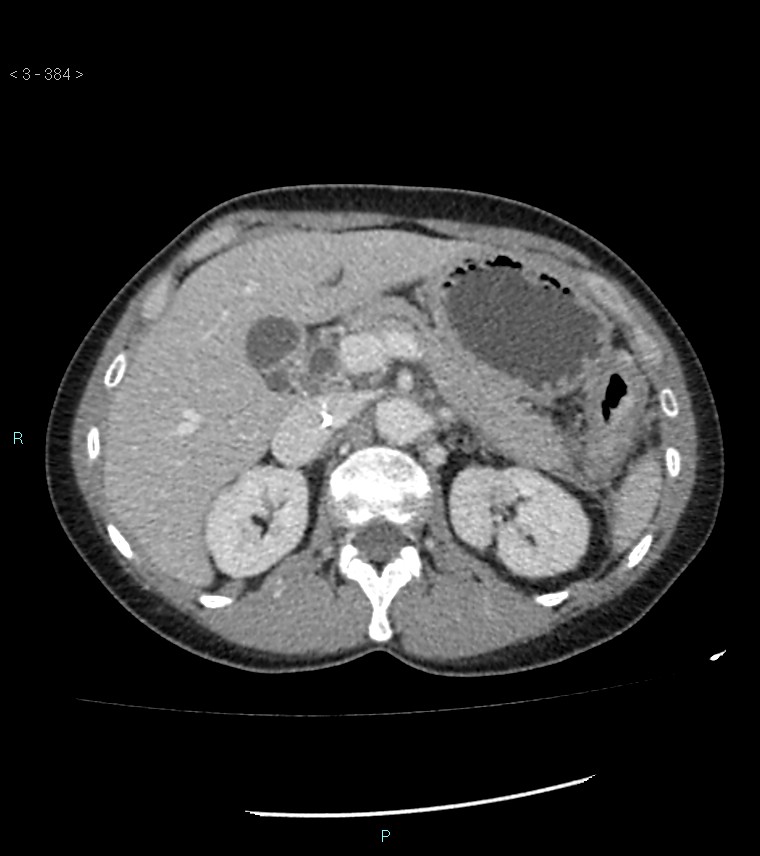 Ampulla of Vater metastasis (Radiopaedia 27820-28069 A 22).jpg