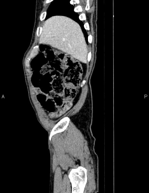 Ampullary adenocarcinoma (Radiopaedia 86093-102032 D 8).jpg