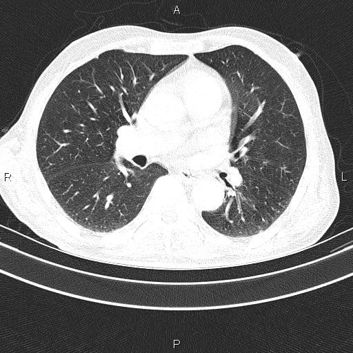Ampullary adenocarcinoma (Radiopaedia 86093-102033 Axial lung window 33).jpg